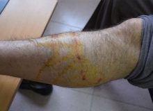 افزایش آمار گازگرفتگی توسط حیوانات